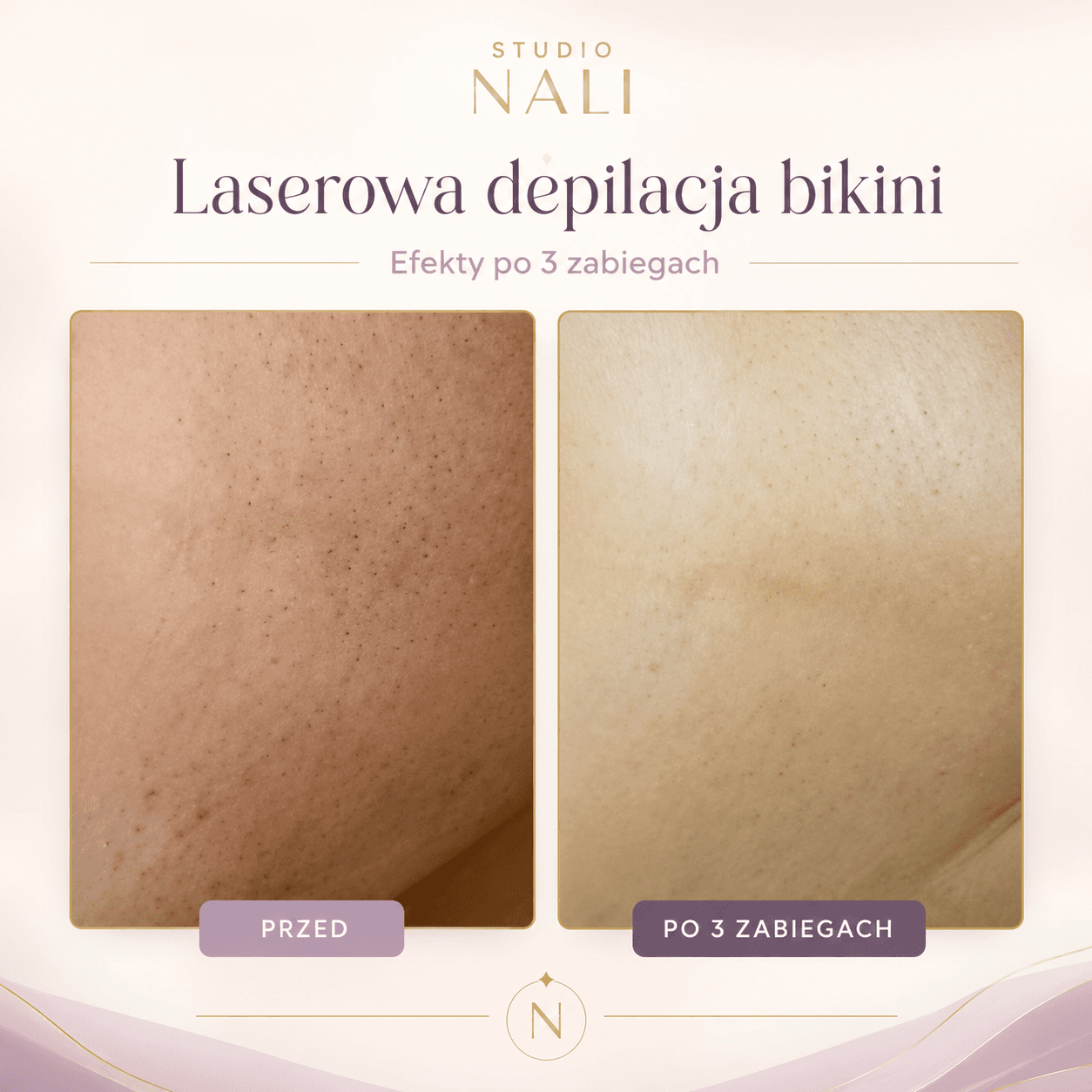 Efekt depilacji laserowej bikini po 3 zabiegach