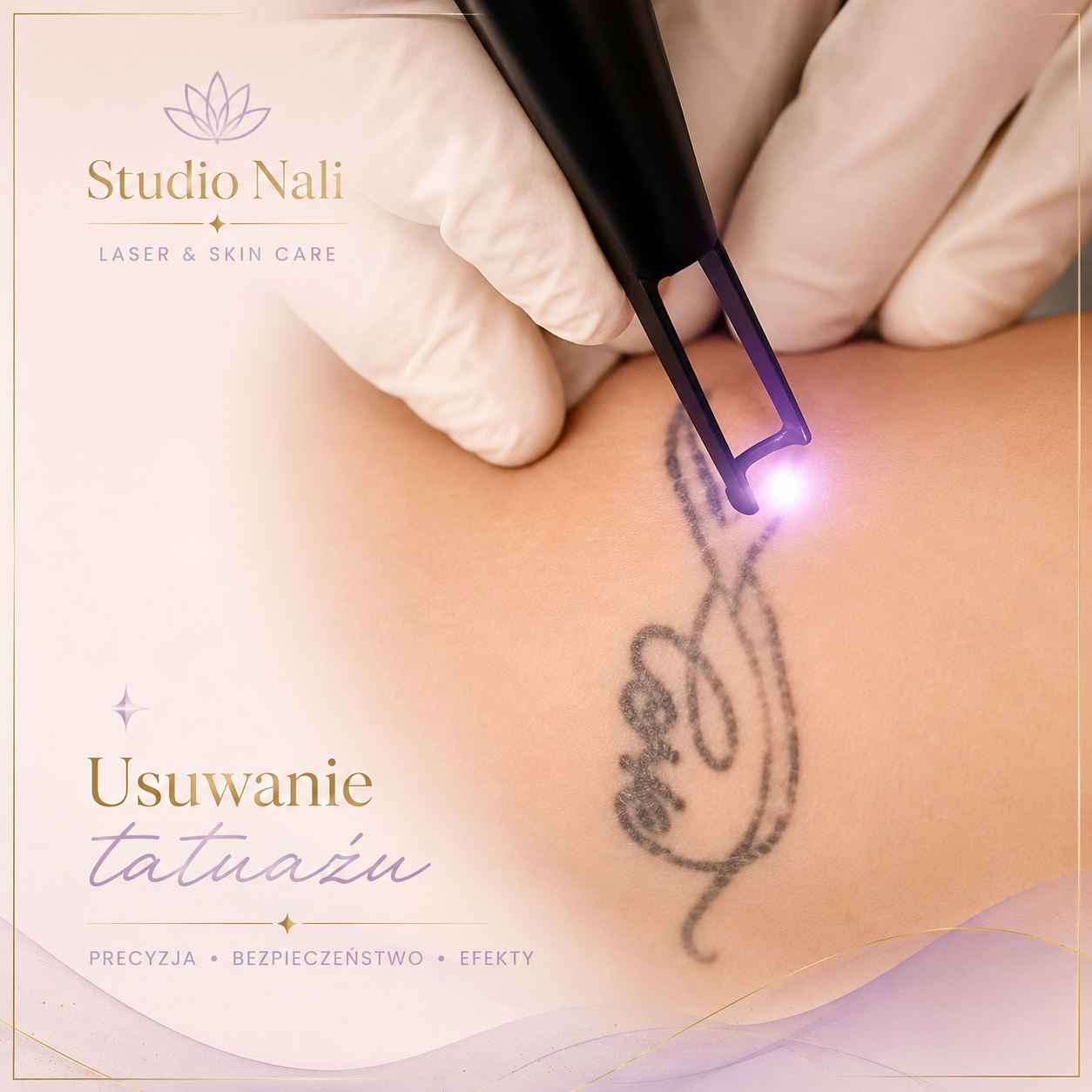 Laserowe usuwanie tatuażu w Studio Nali